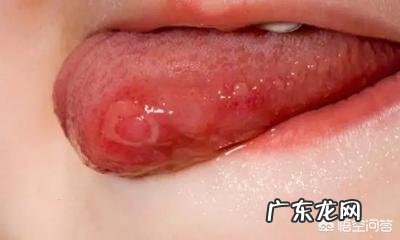 口腔溃疡吃什么东西好得快？