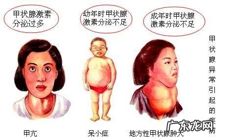 得了甲亢是什么样的一种体验