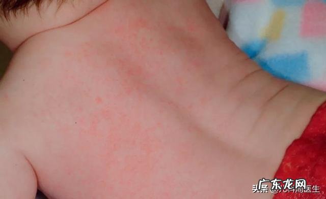 宝宝经常起热痱子，是缺什么东西吗？