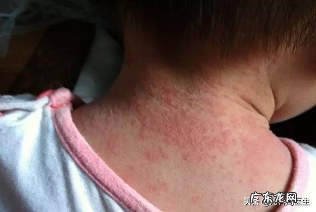 宝宝经常起热痱子，是缺什么东西吗？