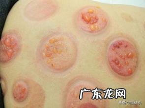 拔火罐不伤身么，功效是什么？