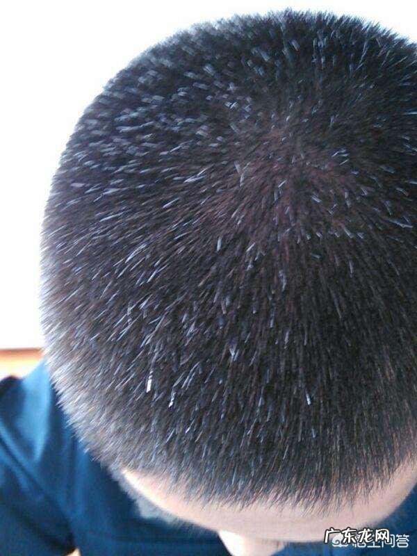 青少年长白头发是什么原因导致的?