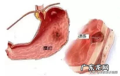 哪些不良的习惯会引起胃出血？