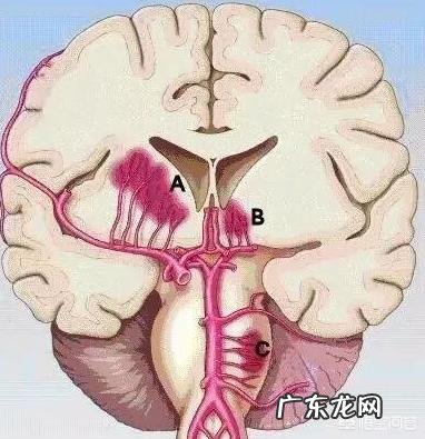 40多岁为什么会脑梗塞?要注意什么?