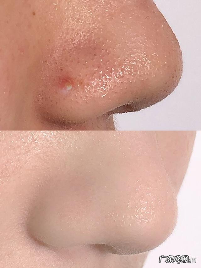 28岁，混油皮肤，额头鼻子下巴爱出油，毛孔粗大黑头，又长痘？