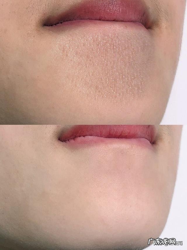 28岁，混油皮肤，额头鼻子下巴爱出油，毛孔粗大黑头，又长痘？