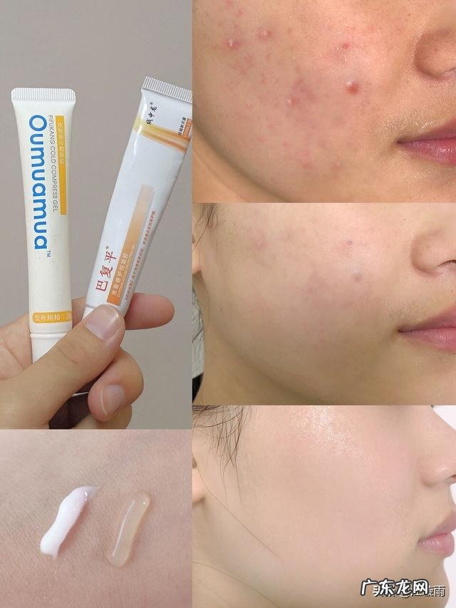 28岁，混油皮肤，额头鼻子下巴爱出油，毛孔粗大黑头，又长痘？