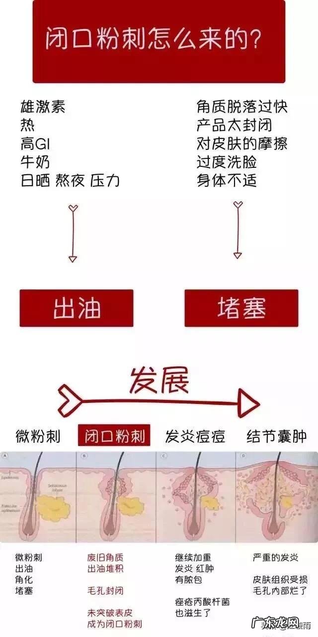 28岁，混油皮肤，额头鼻子下巴爱出油，毛孔粗大黑头，又长痘？