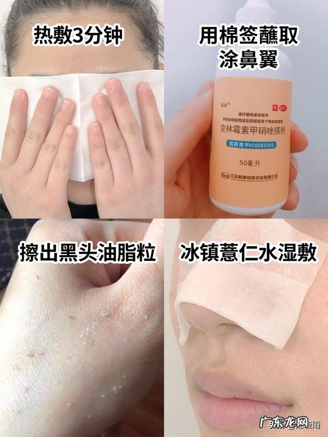 28岁，混油皮肤，额头鼻子下巴爱出油，毛孔粗大黑头，又长痘？