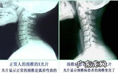 跳广场舞能缓解颈椎病吗？有何依据？