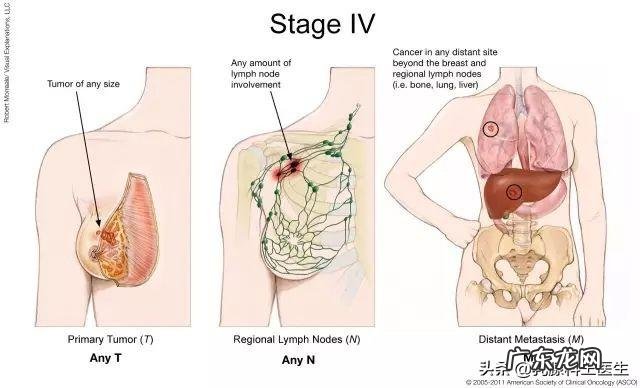 有人说“脾气好”的女子得“乳腺癌”的几率很大,为什么呢?