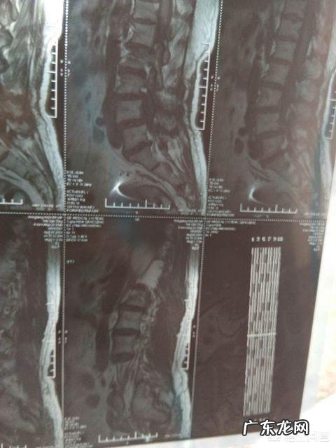 筋膜枪可以按摩腰部吗 自从在按摩店按了腰部以后走路脚疼是怎么回事？
