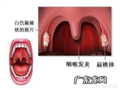 引起咽喉炎的原因可能有哪些？