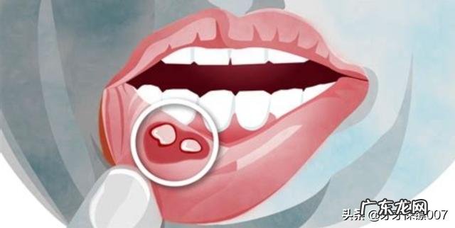 口腔溃疡者除了粥，还能吃什么早餐？