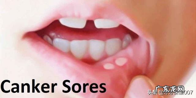 口腔溃疡者除了粥，还能吃什么早餐？