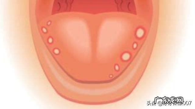 口腔溃疡者除了粥，还能吃什么早餐？