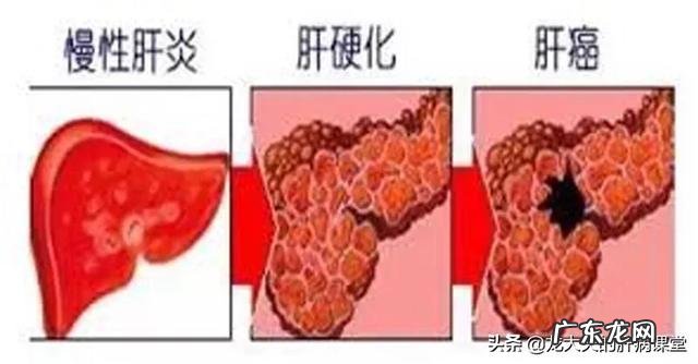 肝炎,肝腹水,肝癌有什么区别和联系