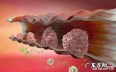 胃息肉切除后，还会复发吗