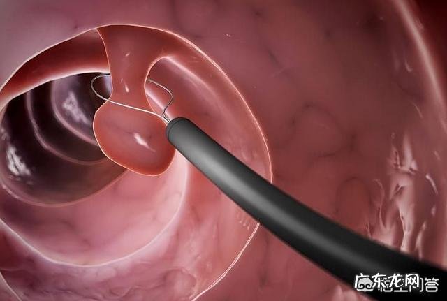 胃息肉切除后,还会复发吗