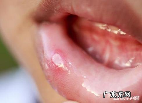 总是反复口腔溃疡,应该吃什么才好?