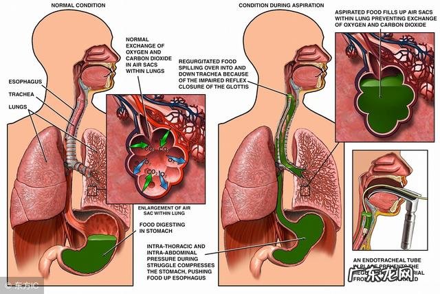 吃完饭总是堵的慌,感觉食物就在嗓子眼里是怎么回事?