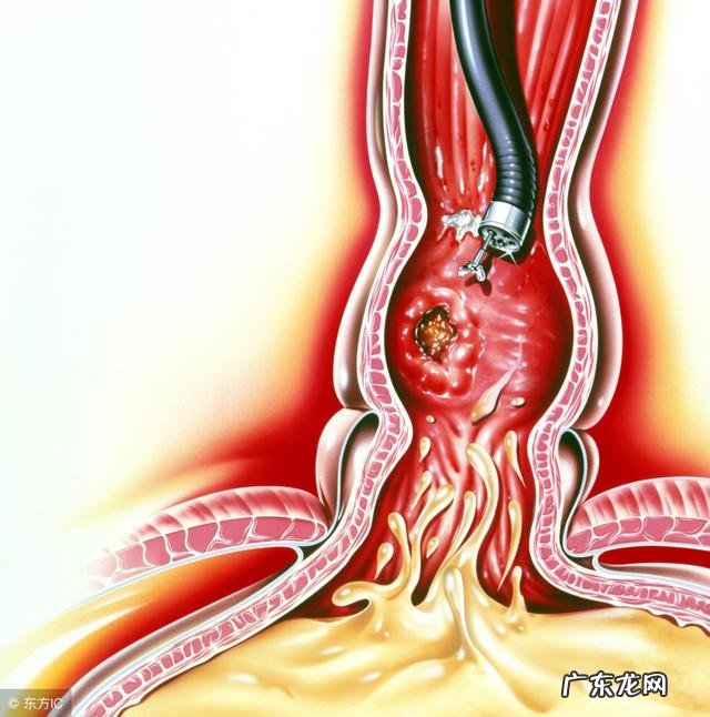 吃完饭总是堵的慌,感觉食物就在嗓子眼里是怎么回事?