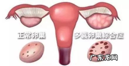 卵巢囊肿会不会癌变?需要手术切除吗?