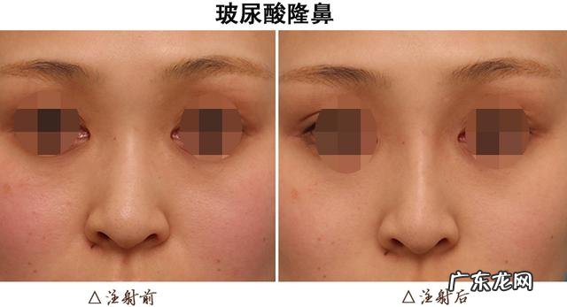 玻尿酸除皱多少钱一支 除皱用肉毒素还是玻尿酸?