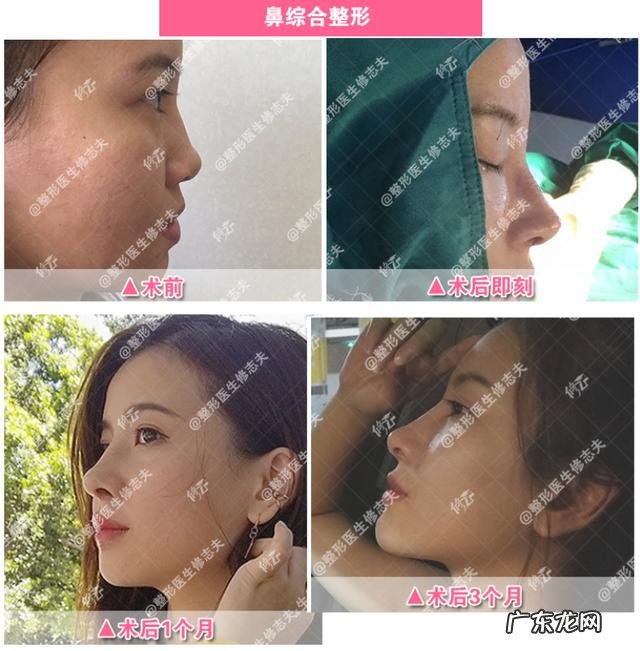 玻尿酸除皱多少钱一支 除皱用肉毒素还是玻尿酸?