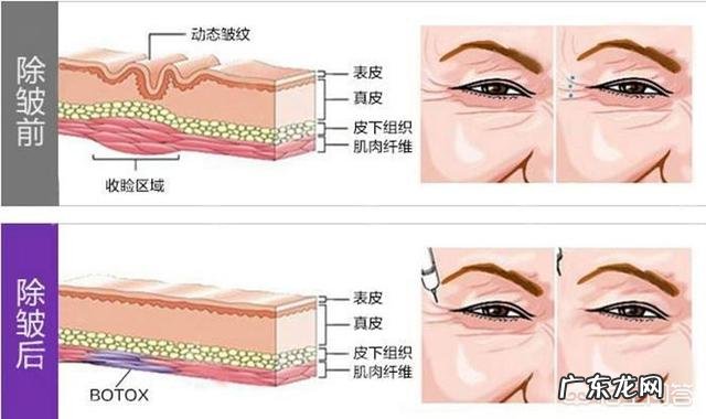 玻尿酸除皱多少钱一支 除皱用肉毒素还是玻尿酸?