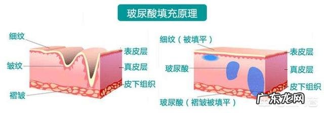 玻尿酸除皱多少钱一支 除皱用肉毒素还是玻尿酸?