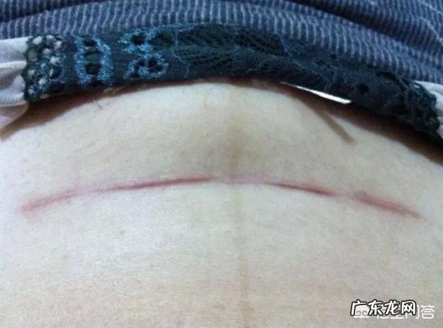剖腹产如何科学护理伤口,可以恢复的快?