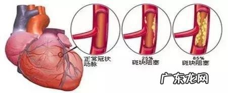 “我不抽烟,也不喝酒,很少应酬,为什么我会得冠心病? 女人不抽烟为什么得冠心病