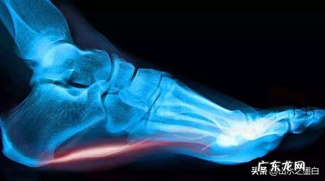 足后跟痛什么原因引起的?