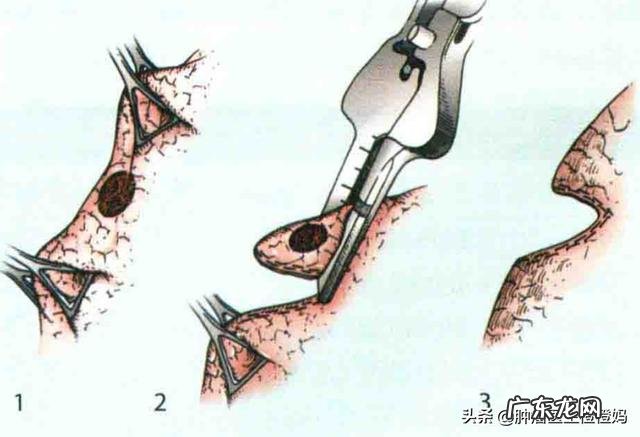 鼻咽癌是什么，该怎么防zhi？ 鼻咽癌的防zhi措施