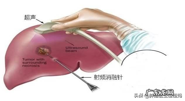 鼻咽癌是什么，该怎么防zhi？ 鼻咽癌的防zhi措施