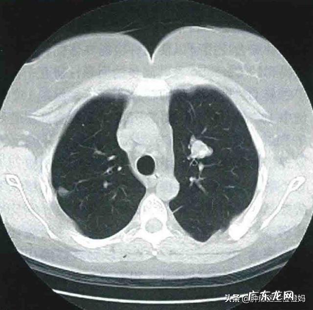 鼻咽癌是什么，该怎么防zhi？ 鼻咽癌的防zhi措施