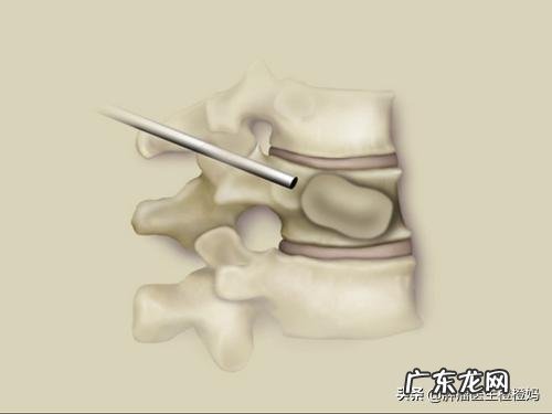 鼻咽癌是什么，该怎么防zhi？ 鼻咽癌的防zhi措施