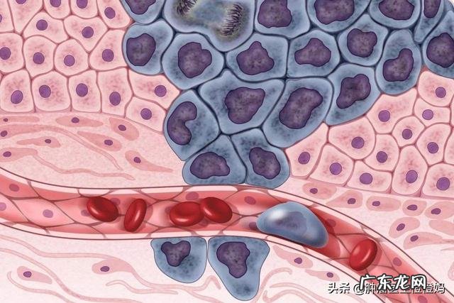 鼻咽癌是什么，该怎么防zhi？ 鼻咽癌的防zhi措施