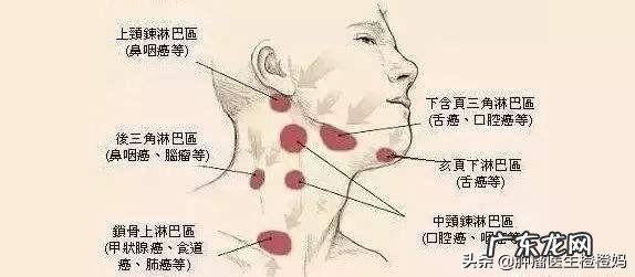鼻咽癌是什么，该怎么防zhi？ 鼻咽癌的防zhi措施