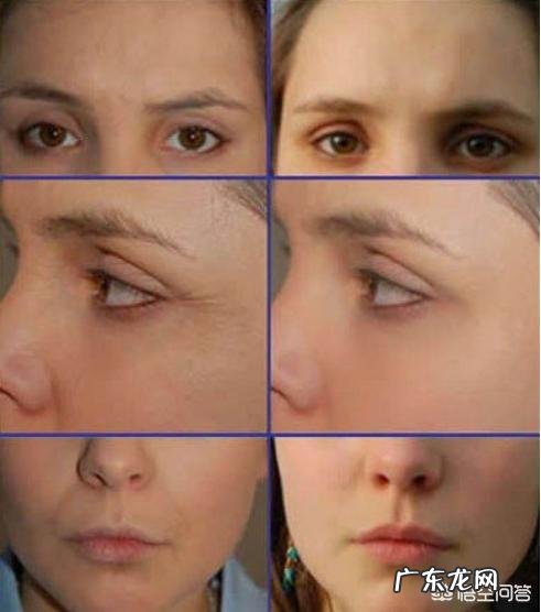 怎样才能让FILLMED玻尿酸保持的更久？