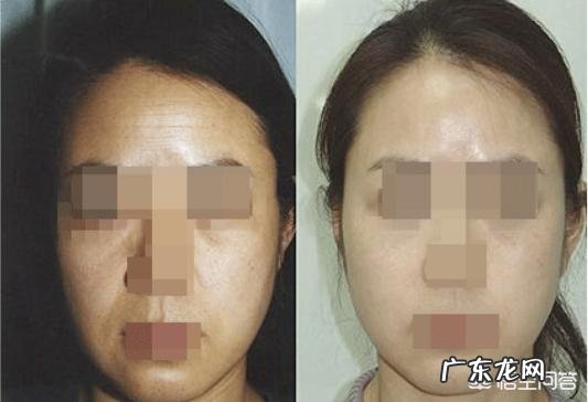 怎样才能让FILLMED玻尿酸保持的更久？