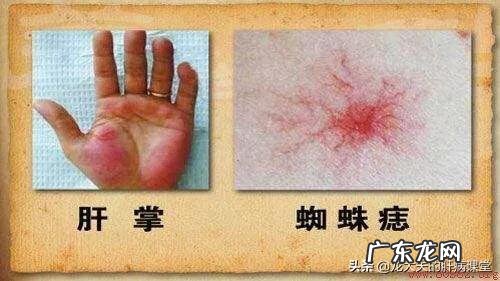 乙肝病毒携带者也会转化为肝癌吗