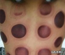 拔完气罐有的部位很黑，这是怎么回事？