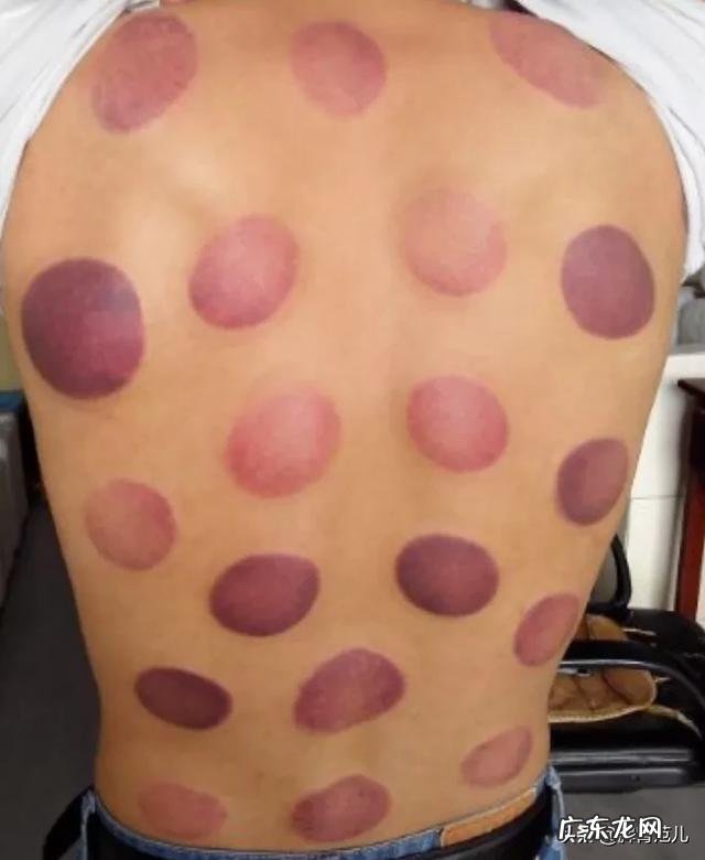 拔完气罐有的部位很黑,这是怎么回事?