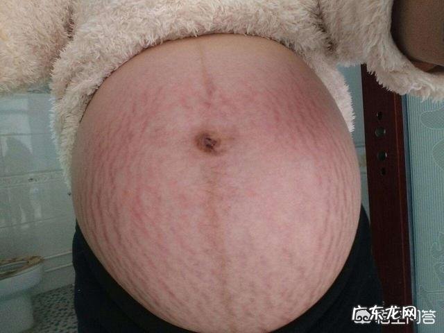 女性怀孕生产过后出现妊娠纹,老公会嫌弃吗?该怎么办?