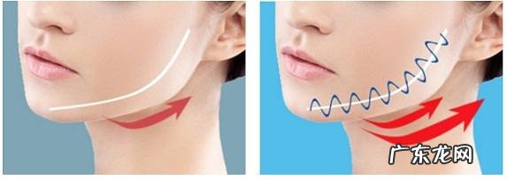 埋线大概得多少钱 请问现在埋线大概多少钱,能保持多久呢?