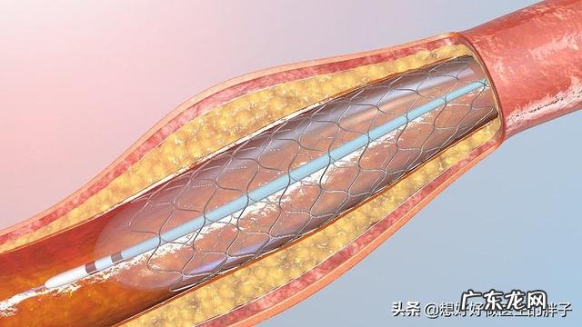 腰、腿不痛，但腿软、凉、麻是啥原因？怎么办？