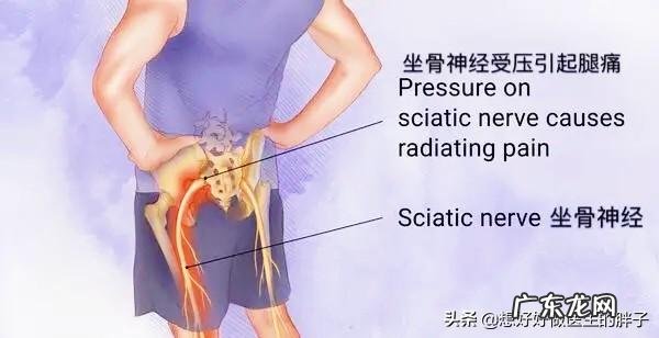 腰、腿不痛，但腿软、凉、麻是啥原因？怎么办？