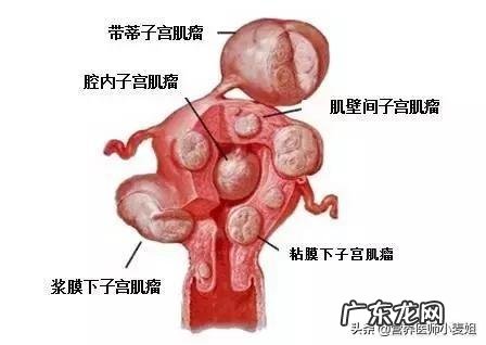 子宫肌瘤吃药可以zhi疗痊愈吗？